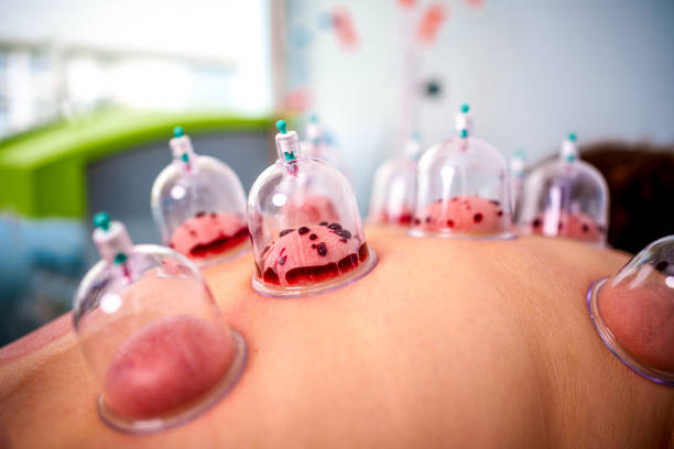 Hijama